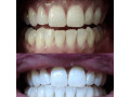 aclaramiento-dental-small-2