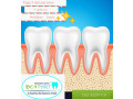 limpieza-dental-gratis-small-0